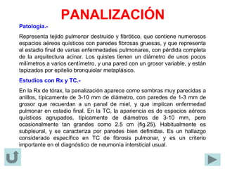 PANALIZACIÓN
Patología.-
Representa tejido pulmonar destruido y fibrótico, que contiene numerosos
espacios aéreos quísticos con paredes fibrosas gruesas, y que representa
el estadio final de varias enfermedades pulmonares, con pérdida completa
de la arquitectura acinar. Los quistes tienen un diámetro de unos pocos
milímetros a varios centímetro, y una pared con un grosor variable, y están
tapizados por epitelio bronquiolar metaplásico.
Estudios con Rx y TC.-
En la Rx de tórax, la panalización aparece como sombras muy parecidas a
anillos, típicamente de 3-10 mm de diámetro, con paredes de 1-3 mm de
grosor que recuerdan a un panal de miel, y que implican enfermedad
pulmonar en estadio final. En la TC, la apariencia es de espacios aéreos
quísticos agrupados, típicamente de diámetros de 3-10 mm, pero
ocasionalmente tan grandes como 2.5 cm (fig.25). Habitualmente es
subpleural, y se caracteriza por paredes bien definidas. Es un hallazgo
considerado específico en TC de fibrosis pulmonar, y es un criterio
importante en el diagnóstico de neumonía intersticial usual.
 