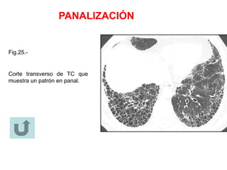 PANALIZACIÓN
Fig.25.-
Corte transverso de TC que
muestra un patrón en panal.
 