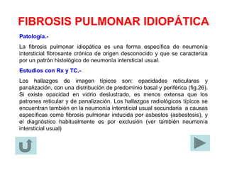 FIBROSIS PULMONAR IDIOPÁTICA
Patología.-
La fibrosis pulmonar idiopática es una forma específica de neumonía
intersticial fibrosante crónica de origen desconocido y que se caracteriza
por un patrón histológico de neumonía intersticial usual.
Estudios con Rx y TC.-
Los hallazgos de imagen típicos son: opacidades reticulares y
panalización, con una distribución de predominio basal y periférica (fig.26).
Si existe opacidad en vidrio deslustrado, es menos extensa que los
patrones reticular y de panalización. Los hallazgos radiológicos típicos se
encuentran también en la neumonía intersticial usual secundaria a causas
específicas como fibrosis pulmonar inducida por asbestos (asbestosis), y
el diagnóstico habitualmente es por exclusión (ver también neumonía
intersticial usual)
 