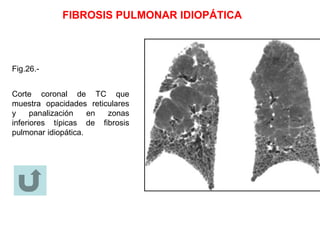 FIBROSIS PULMONAR IDIOPÁTICA
Fig.26.-
Corte coronal de TC que
muestra opacidades reticulares
y panalización en zonas
inferiores típicas de fibrosis
pulmonar idiopática.
 