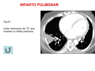 INFARTO PULMONAR
Fig.27.-
Corte transverso de TC que
muestra un infarto pulmonar.
 