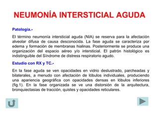 NEUMONÍA INTERSTICIAL AGUDA
Patología.-
El término neumonía intersticial aguda (NIA) se reserva para la afectación
alveolar difusa de causa desconocida. La fase aguda se caracteriza por
edema y formación de membranas hialinas. Posteriormente se produce una
organización del espacio aéreo y/o intersticial. El patrón histológico es
indistinguible del Síndrome de distress respiratorio agudo.
Estudio con RX y TC.-
En la fase aguda se ven opacidades en vidrio deslustrado, parcheadas y
bilaterales, a menudo con afectación de lóbulos individuales, produciendo
una apariencia geográfica con opacidades densas en lóbulos inferiores
(fig.1). En la fase organizada se ve una distorsión de la arquitectura,
bronquiectasias de tracción, quistes y opacidades reticulares.
 