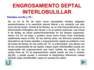 ENGROSAMIENTO SEPTAL
INTERLOBULILLAR
Estudios con Rx y TC.-
Se ve en la Rx de tórax como opacidades lineales delgadas
perpendiculares a la superficie pleural lateral y en contacto con ella,
cerca de las bases (líneas B de Kerley); se ve más frecuentemente en la
diseminación linfangítica del cáncer o en el edema pulmonar. Las líneas
A de Kerley se sitúan predominantemente en los lóbulos superiores,
tienen 2-6 cm de largo y pueden verse como líneas finas orientadas
radialmente hacia el hilio. En los últimos años, los términos anatómicos
descriptivos de líneas septales y engrosamiento septal se prefieren a los
de líneas de Kerley. En los cortes de TC, la enfermedad que afecta uno
de los componentes de los septos (véase septo interlobulillar) puede ser
responsable del engrosamiento que hace visibles los septos. En los
cortes finos de TC el engrosamiento septal puede ser liso o nodular
(fig.28), y puede ayudar a concretar el diagnóstico diferencial (véase
también septo interlobulillar, septo en cuentas de collar).
 