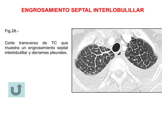 ENGROSAMIENTO SEPTAL INTERLOBULILLAR
Fig.28.-
Corte transverso de TC que
muestra un engrosamiento septal
interlobulillar y derrames pleurales.
 
