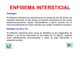 ENFISEMA INTERSTICIAL
Patología.-
El enfisema intersticial se caracteriza por la existencia de aire dentro del
intersticio pulmonar, al que diseca; se localiza típicamente en las vainas
peribroncovasculares, septos interlobulillares y pleura visceral. Se ve
más frecuentemente en recién nacidos que reciben ventilación mecánica.
Estudios con Rx y TC.-
El enfisema intersticial raras veces se identifica en las radiografías de
adultos, y de forma infrecuente en los cortes de TC (fig.30). Aparece
como radiolucencias perivasculares o halos de baja atenuación y
pequeños quistes.
 