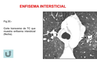 ENFISEMA INTERSTICIAL
Fig.30.-
Corte transverso de TC que
muestra enfisema intersticial
(flecha).
 