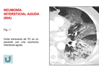 NEUMONÍA
INTERSTICIAL AGUDA
(NIA)
Corte transverso de TC en un
paciente con una neumonía
intersticial aguda.
Fig.- 1
 