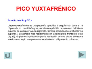 PICO YUXTAFRÉNICO
Estudio con Rx y TC.-
Un pico yuxtafrénico es una pequeña opacidad triangular con base en la
cúpula de un hemidiafragma, asociado a pérdida de volumen del lóbulo
superior de cualquier causa (ejemplo, fibrosis posradiación o lobectomía
superior.). Se aprecia más rápidamente en la radiografía frontal de tórax
(fig.32). El pico está producido por la retracción de una cisura accesoria
inferior o un septo intrapulmonar asociado con el ligamento pulmonar.
 