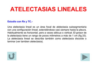 ATELECTASIAS LINEALES
Estudio con Rx y TC.-
Una atelectasia lineal es un área focal de atelectasia subsegmentaria
con una configuración lineal, extendiéndose casi siempre hasta la pleura.
Habitualmente es horizontal, pero a veces oblicua o vertical. El grosor de
la atelectasia tiene un rango de pocos milimetros a más de 1 cm (fig.33).
La atelectasia lineal se describe también como atelectasia discoide o
laminar (ver tambien atelectasia).
 