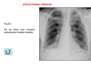 ATELECTASIAS LINEALES
Fig.33.-
Rx de tórax que muestra
atelectasias lineales basales.
 