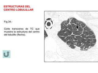 ESTRUCTURAS DEL
CENTRO LOBULILLAR
Fig.34.-
Corte transverso de TC que
muestra la estructura del centro
del lobulillo (flecha).
 