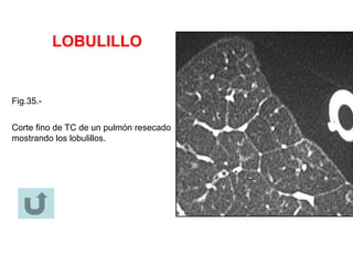 LOBULILLO
Fig.35.-
Corte fino de TC de un pulmón resecado
mostrando los lobulillos.
 