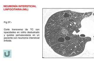 NEUMONÍA INTERSTICIAL
LINFOCITARIA (NIL)
Fig.37.-
Corte transverso de TC con
opacidades en vidrio deslustrado
y quistes perivasculares en un
paciente con neumonía intersticial
linfoide.
 