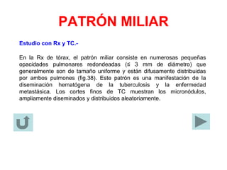 PATRÓN MILIAR
Estudio con Rx y TC.-
En la Rx de tórax, el patrón miliar consiste en numerosas pequeñas
opacidades pulmonares redondeadas (≤ 3 mm de diámetro) que
generalmente son de tamaño uniforme y están difusamente distribuidas
por ambos pulmones (fig.38). Este patrón es una manifestación de la
diseminación hematógena de la tuberculosis y la enfermedad
metastásica. Los cortes finos de TC muestran los micronódulos,
ampliamente diseminados y distribuidos aleatoriamente.
 