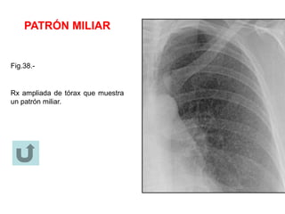 PATRÓN MILIAR
Fig.38.-
Rx ampliada de tórax que muestra
un patrón miliar.
 