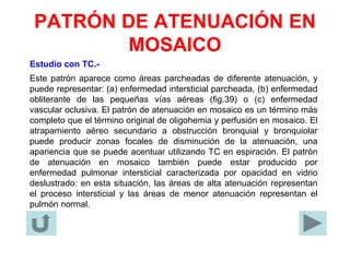 PATRÓN DE ATENUACIÓN EN
MOSAICO
Estudio con TC.-
Este patrón aparece como áreas parcheadas de diferente atenuación, y
puede representar: (a) enfermedad intersticial parcheada, (b) enfermedad
obliterante de las pequeñas vías aéreas (fig.39) o (c) enfermedad
vascular oclusiva. El patrón de atenuación en mosaico es un término más
completo que el término original de oligohemia y perfusión en mosaico. El
atrapamiento aéreo secundario a obstrucción bronquial y bronquiolar
puede producir zonas focales de disminución de la atenuación, una
apariencia que se puede acentuar utilizando TC en espiración. El patrón
de atenuación en mosaico también puede estar producido por
enfermedad pulmonar intersticial caracterizada por opacidad en vidrio
deslustrado: en esta situación, las áreas de alta atenuación representan
el proceso intersticial y las áreas de menor atenuación representan el
pulmón normal.
 