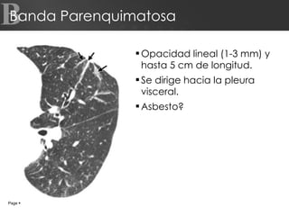 Banda Parenquimatosa Opacidad lineal (1-3 mm) y hasta 5 cm de longitud. Se dirige hacia la pleura visceral. Asbesto? B Page     