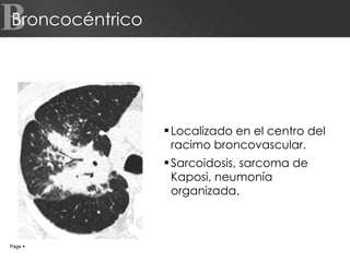 Broncocéntrico Localizado en el centro del racimo broncovascular. Sarcoidosis, sarcoma de Kaposi, neumonía organizada. B Page     