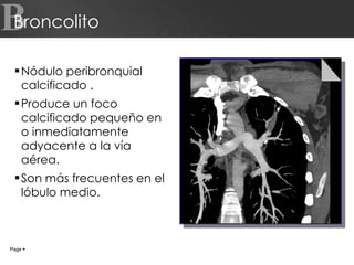 Nódulo peribronquial calcificado . Produce un foco calcificado pequeño en o inmediatamente adyacente a la vía aérea. Son más frecuentes en el lóbulo medio. Broncolito Page     B 