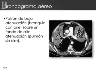 Broncograma aéreo Patrón de baja atenuación (bronquio con aire) sobre un fondo de alta atenuación (pulmón sin aire). Page     B 