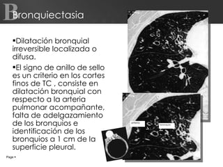 Bronquiectasia Dilatación bronquial irreversible localizada o difusa. El signo de anillo de sello es un criterio en los cortes finos de TC , consiste en dilatación bronquial con respecto a la arteria pulmonar acompañante, falta de adelgazamiento de los bronquios e identificación de los bronquios a 1 cm de la superficie pleural. Page     B arteria bronquio 