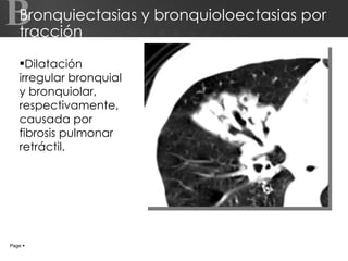 Bronquiectasias y bronquioloectasias por tracción Dilatación irregular bronquial y bronquiolar, respectivamente,  causada por fibrosis pulmonar retráctil. Page     B 