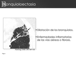 Bronquioloectasia Dilatación de los bronquiolos.  Enfermedades inflamatorias de las vías aéreas o fibrosis. B Page     Radiology 2008; 246: 697-722 