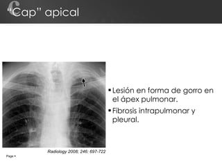 “Cap” apical Lesión en forma de gorro en el ápex pulmonar. Fibrosis intrapulmonar y pleural. c Page     Radiology 2008; 246: 697-722 
