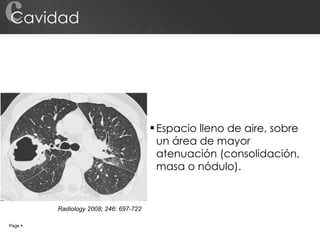 Cavidad Espacio lleno de aire, sobre un área de mayor atenuación (consolidación, masa o nódulo). c Page     Radiology 2008; 246: 697-722 