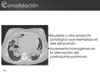 Consolidación Exudado u otro producto patológico que reemplaza el aire del pulmón. Incremento homogéneo en la atenuación del parénquima pulmonar. c Page     