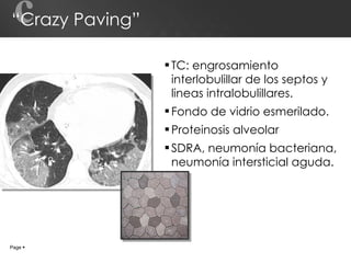 “Crazy Paving” TC: engrosamiento interlobulillar de los septos y lineas intralobulillares.  Fondo de vidrio esmerilado. Proteinosis alveolar SDRA, neumonía bacteriana, neumonía intersticial aguda. c Page     