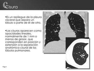 Cisura Es un repliegue de la pleura visceral que separa un lóbulo o parte de él de otro. Las cisuras aparecen como opacidades lineales, normalmente de 1 mm o menos de grosor, que corresponden en posición y extensión a la separación anatómica cisural de los lóbulos pulmonares. Page     c 