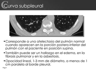 Curva subpleural  Corresponde a una atelectasia del pulmón normal cuando aparecen en la porción postero-inferior del pulmón con el paciente en posición supina. También puede ser un hallazgo en el edema, en la fibrosis pulmonar y en la asbestosis. Opacidad lineal, 1-3 mm de diámetro, a menos de 1 cm paralela al borde pleural. Page     C 