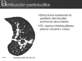 Distribución perilobulillar Estructuras rodeando la periferia del lobulillo pulmonar secundario. TC: septos interlobulillares, pleura visceral y vasos D Page     Radiology 2008; 246: 697-722 