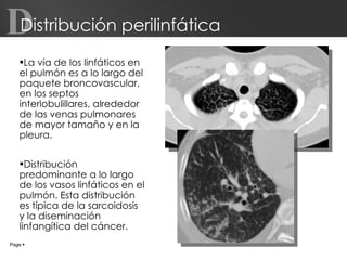 Distribución perilinfática  La vía de los linfáticos en el pulmón es a lo largo del paquete broncovascular, en los septos interlobulillares, alrededor de las venas pulmonares de mayor tamaño y en la pleura.  Distribución predominante a lo largo de los vasos linfáticos en el pulmón. Esta distribución es típica de la sarcoidosis y la diseminación linfangítica del cáncer. Page     D 