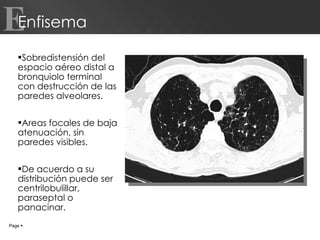 Enfisema Sobredistensión del espacio aéreo distal a bronquiolo terminal con destrucción de las paredes alveolares. Areas focales de baja atenuación, sin paredes visibles.  De acuerdo a su distribución puede ser centrilobulillar, paraseptal o panacinar. Page     E 