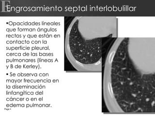 Engrosamiento septal interlobulillar Opacidades lineales que forman ángulos rectos y que están en contacto con la superficie pleural, cerca de las bases pulmonares (líneas A y B de Kerley). Se observa con mayor frecuencia en la diseminación linfangítica del cáncer o en el edema pulmonar. Page     E 