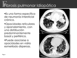 Fibrosis pulmonar Idiopática Es una forma específica de neumonía intersticial crónica. Opacidades reticulares y apanalamiento, con  una distribución predominantemente basal y periférica. Puede asociarse a opacidades en vidrio esmerilado dispersas. Page     F 