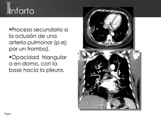 Infarto Proceso secundario a la oclusión de una arteria pulmonar (p.ej: por un trombo). Opacidad  triangular o en domo, con la base hacia la pleura. Page     I 