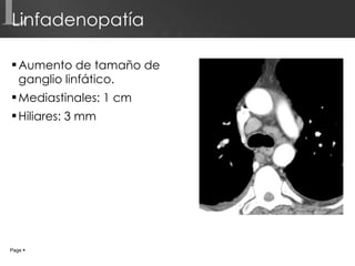 Linfadenopatía Aumento de tamaño de ganglio linfático. Mediastinales: 1 cm Hiliares: 3 mm L Page     