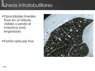 Líneas intralobulillares Opacidades lineales finas en un lóbulo visibles cuando el intersticio está engrosado. Patrón reticular fino L Page     