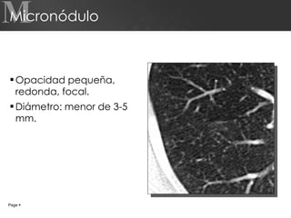 Micronódulo Opacidad pequeña, redonda, focal. Diámetro: menor de 3-5 mm. M Page     