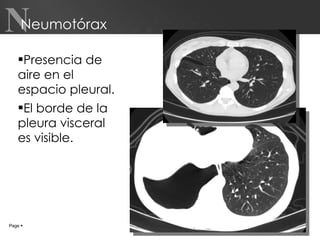 Neumotórax Presencia de aire en el espacio pleural. El borde de la pleura visceral es visible. Page     N 