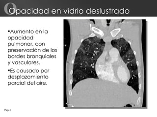 Opacidad en vidrio deslustrado Aumento en la opacidad pulmonar, con preservación de los bordes bronquiales y vasculares.  Es causado por desplazamiento parcial del aire. Page     O 