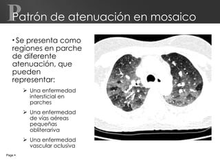 Patrón de atenuación en mosaico Se presenta como regiones en parche de diferente atenuación, que pueden representar:  Una enfermedad intersticial en parches Una enfermedad de vías aéreas pequeñas obliterariva Una enfermedad vascular oclusiva Page     P 