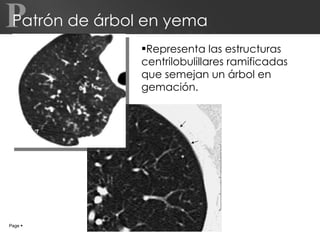 Patrón de árbol en yema Representa las estructuras centrilobulillares ramificadas que semejan un árbol en gemación. Page     P 