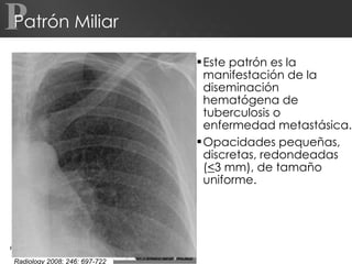 Patrón Miliar Este patrón es la manifestación de la diseminación hematógena de tuberculosis o enfermedad metastásica. Opacidades pequeñas, discretas, redondeadas ( < 3 mm), de tamaño uniforme. Page     P Radiology 2008; 246: 697-722 