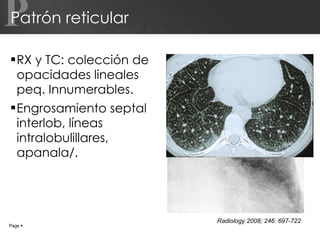 Patrón reticular RX y TC: colección de opacidades lineales peq. Innumerables. Engrosamiento septal interlob, líneas intralobulillares, apanala/. P Page     Radiology 2008; 246: 697-722 