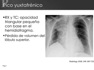 Pico yuxtafrénico RX y TC: opacidad triangular pequeña con base en el hemidiafragma. Pérdida de volumen del lóbulo superior. P Page     Radiology 2008; 246: 697-722 