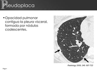 Pseudoplaca Opacidad pulmonar contigua la pleura visceral, formada por nódulos coalescentes. P Page     Radiology 2008; 246: 697-722 
